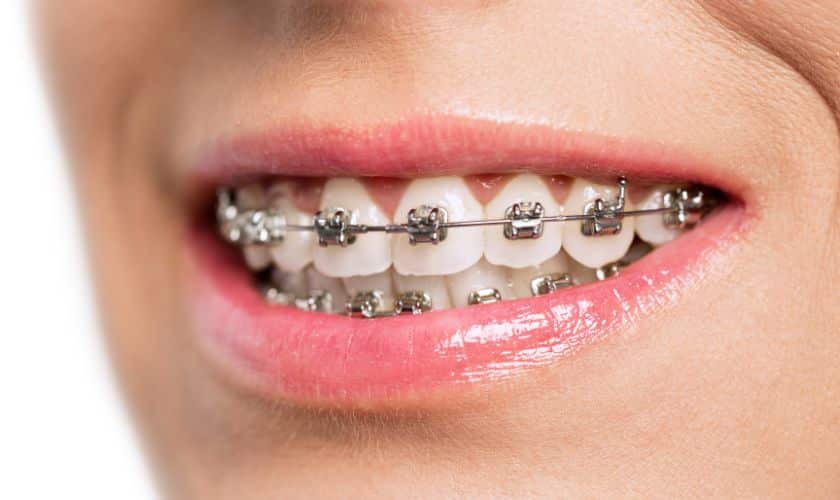How To Choose The Right Orthodontist For Braces in Falcon?