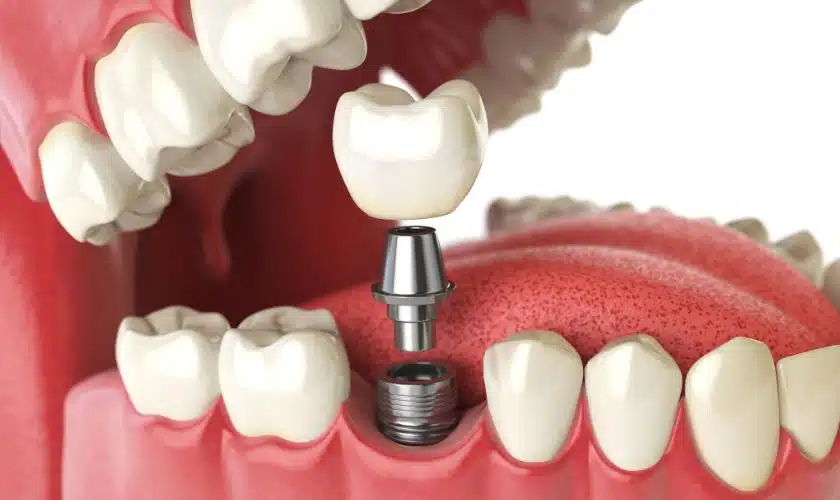 The Importance of Proper Dental Implant Placement for Success