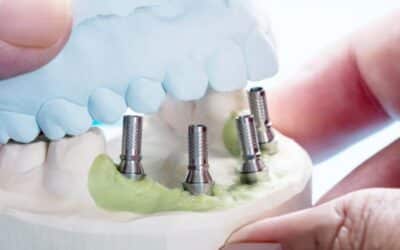 How Many Dental Implants Can Be Placed at One Time?