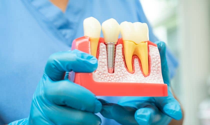 What is the Right Age to Consider Dental Implants?